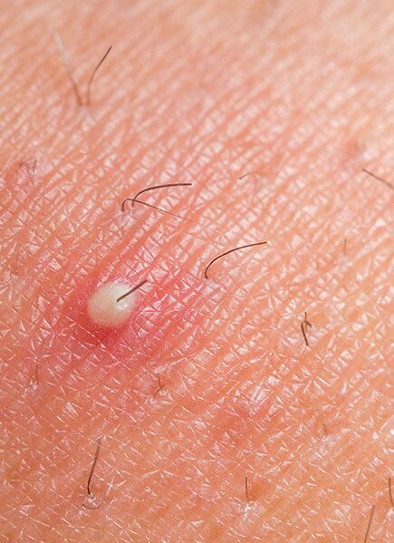 What Causes Ingrown Hair  How to Treat Ingrown Hair  Soft Services  the  body skin experts 